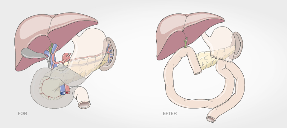 Operationer i maven – før og efter
